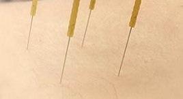 Dry Needling Treatment in Hong Kong