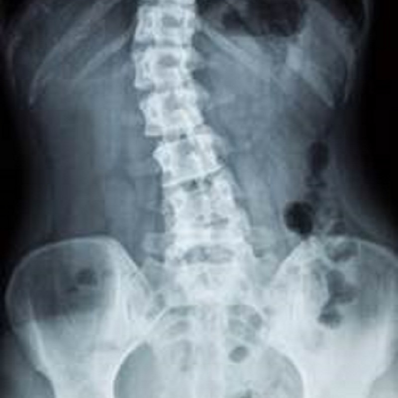 腰痛常見病因, 脊椎側彎